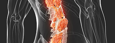 Backpain