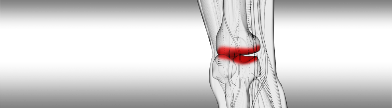 Transform patients’ lives living with Osteoarthritis