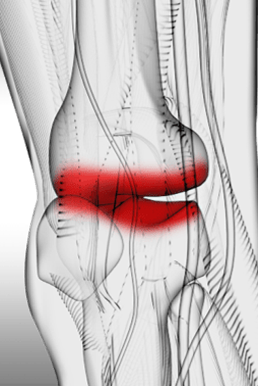 Transform patients’ lives living with Osteoarthritis